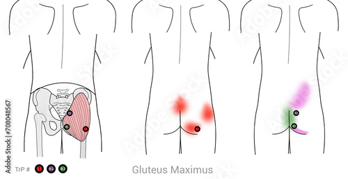 Gluteus Maximus: Myofascial trigger points and associated pain locations photo