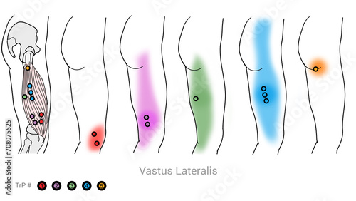 Quadriceps ,Vastus Lateralis: Myofascial trigger points and associated pain locations photo
