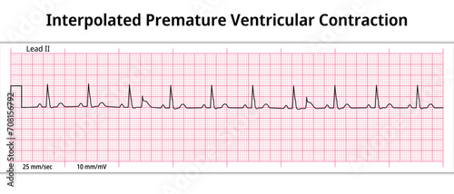 ECG Interpolated Premature Ventricular Contraction - Ventricular Extrasystole - 8 Second ECG Paper - Electrocardiogram Vector Medical Illustration