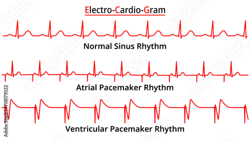Set of ECG Common Abnormalities - Atrial vs Ventricular Pacemaker Rhythm - Single Chamber - Electrocardiogram Vector Medical Illustration
