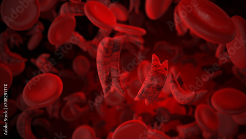 Sickle cell disease medical concept