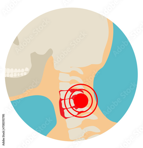 Cervical spine have a red signal. Neck disease, neck injury. Rheumatoid arthritis swelling of. Illustration about diagnose body injury. Health problems. Flat style