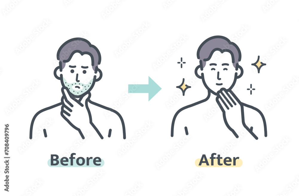 ヒゲ脱毛のビフォーアフター ヒゲ脱毛のビフォーアフター