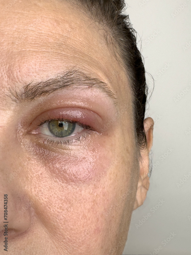 Obraz premium Closeup female patient's infected eye
