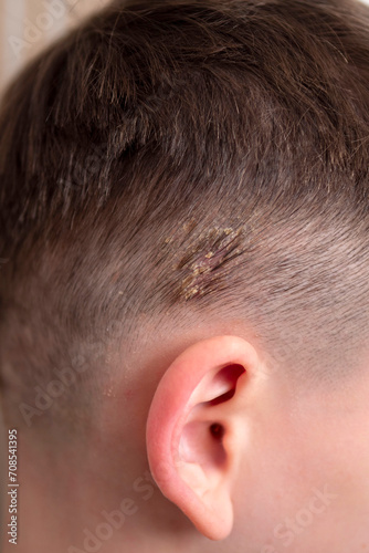 Host formation on the scalp of the head in children, host disease on the scalp, © kodbanker