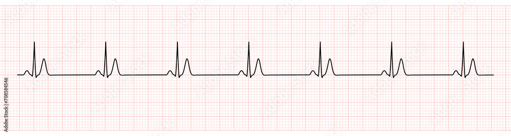 EKG Monitor Showing  Sinus Rhythm with Short QT interval