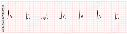 EKG Monitor Showing  Sinus Rhythm with Short QT interval