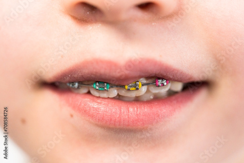 Little girl with rainbow braces