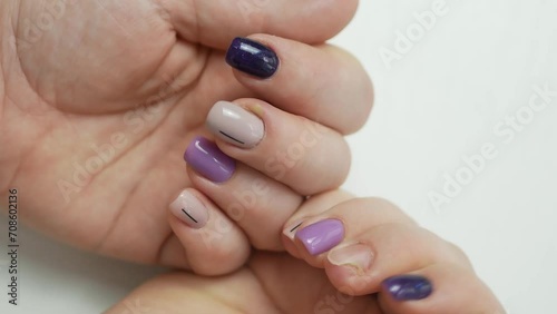Women's hands with a beautiful manicure with a swollen finger from inflammation due to infection and a fungal nail, a finger with pus next to the nail of paronychia. photo