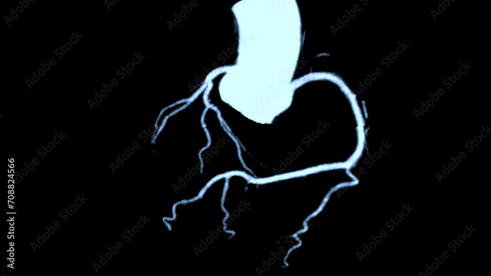 Fototapeta premium CTA coronary artery 3D rendering is a diagnostic imaging technique capturing detailed visuals of the heart's blood vessels in diagnosing coronary artery diseases and assessing cardiac health.
