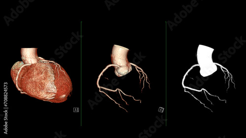 Tableau sur toile CTA coronary artery 3D rendering is a diagnostic imaging technique capturing detailed visuals of the heart's blood vessels in diagnosing coronary artery diseases and assessing cardiac health