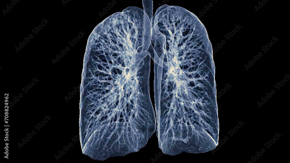 CT Chest or Lung 3d rendering image showing Trachea and lung in respiratory system.. CT Chest or Lung 3d rendering image showing Trachea and lung in respiratory system..