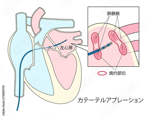 心房細動治療のカテーテルアブレーションのイラスト