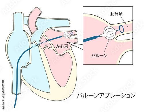 心房細動治療のバルーンアブレーションのイラスト