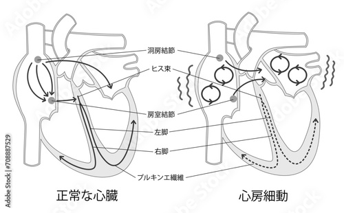 正常な心臓と心房細動の比較イラスト白黒