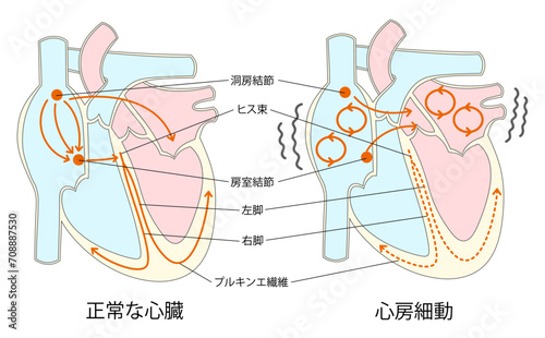 正常な心臓と心房細動の比較イラスト