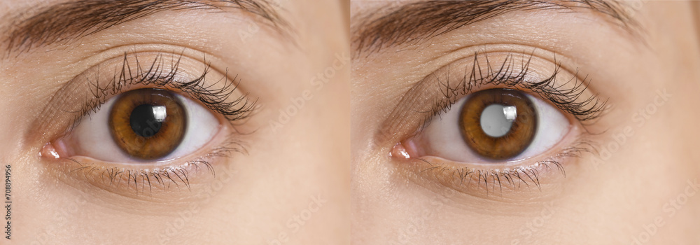 Naklejka premium Closeup view of woman before and after glaucoma treatment, closeup