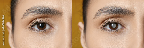 Closeup view of woman before and after glaucoma treatment on yellow background, closeup photo
