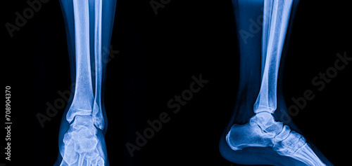 Plain x-ray AP Lateral views of ankle showing syndesmotic ankle sprain, an injury of ligaments. Normal ankle or ankle sprain.Blue tone imaging on black background with space.Medical and orthopedic.