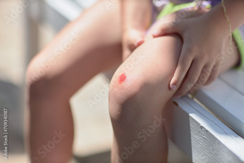 Wounded knee of the child. Abrasion on the lap of baby close-up after the fall. A scratch with blood. Body trauma. photo