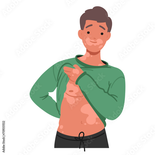 Man Proudly Showcasing His Vitiligo, Embracing Diversity And Radiating Happiness. His Positive Spirit Promotes Self-love