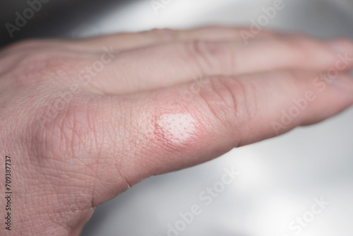 Burned skin on a finger of Caucasians man hand -close up
