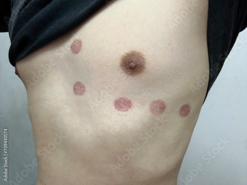Man having red spots on human skin on the chest after testing ECG or EKG using electrodes to check and record heart rate and pulse This skin irritation and redness can resolve on its own 