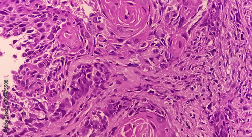 Invasive squamous cell carcinoma of larynx grade 2 photo