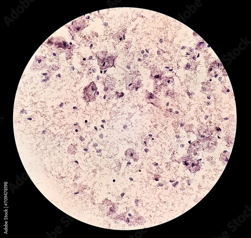 Trichomonas vaginalis is an anaerobic, flagellated protozoan parasite and the causative agent of trichomoniasis.