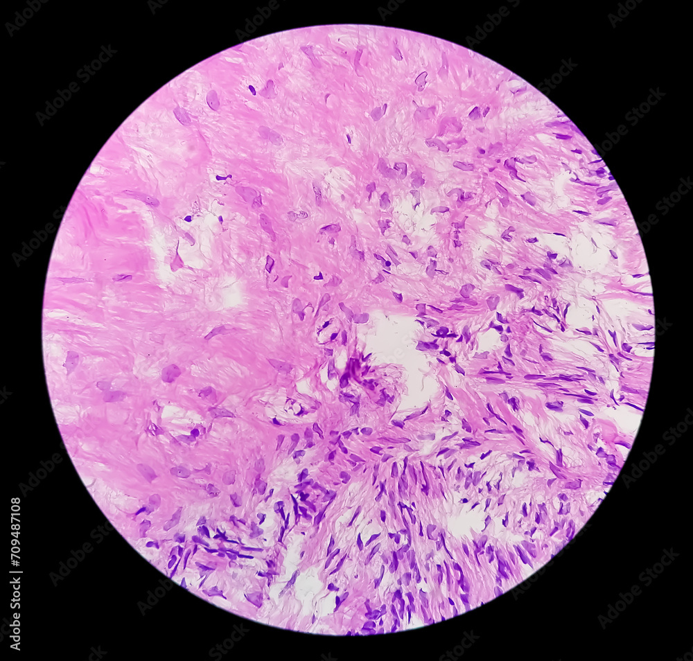 Histopathological photomicrograph of ovarian cyst showing Metastatic cystic teratoma. Histopathological photomicrograph of ovarian cyst showing Metastatic cystic teratoma.