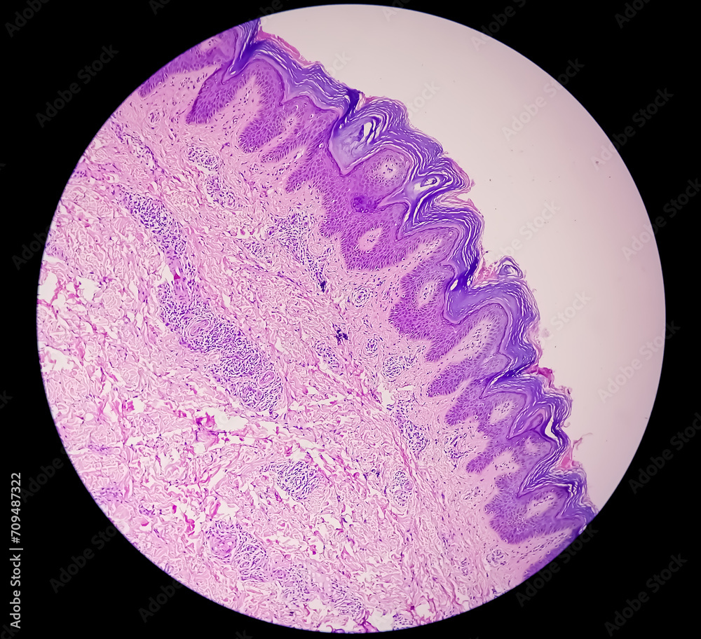 Histological Photomicrograph: Prurigo nodularis (PN) is a chronic disorder of the skin. Histological Photomicrograph: Prurigo nodularis (PN) is a chronic disorder of the skin.