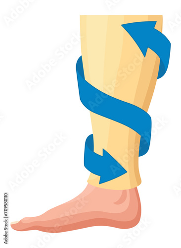 Stages or types of varicose veins development. Medical poster or disease infographic. Image of diseased legs. Vector illustration in flat style