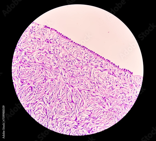 Histology, Peritoneal inclusion cyst. Paraovarian cysts, hydrosalpinx and low-grade cystic mesothelioma are usually considered in the differential diagnosis of PICs. photo