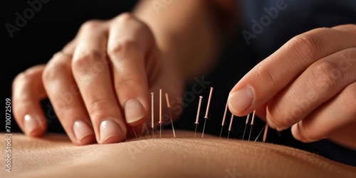 Close up shot of an acupuncture therapy process with steel needles during a procedure