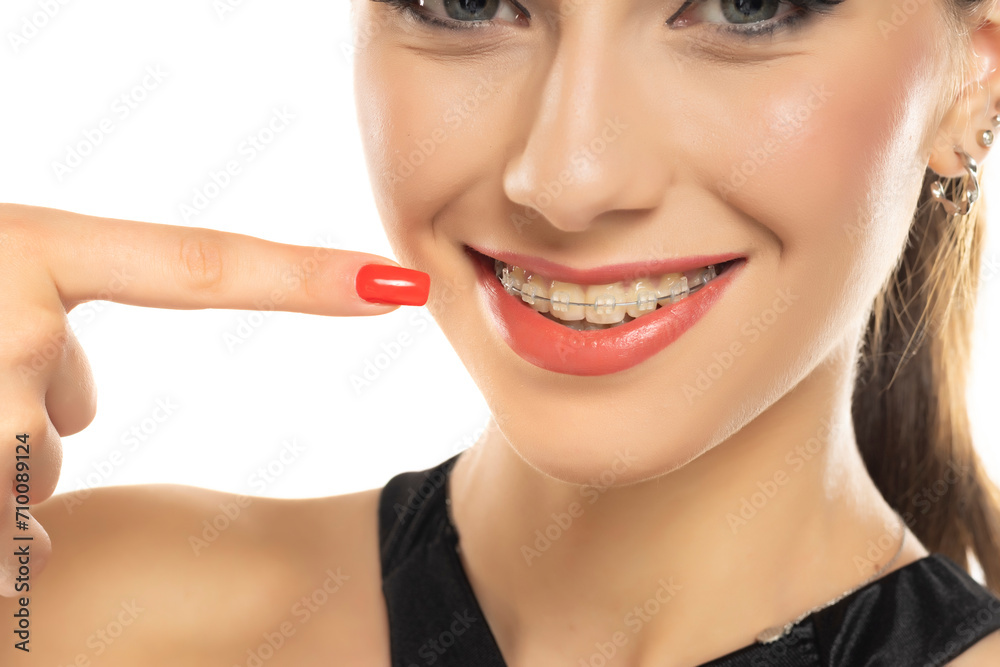 Face of a young smiling beautiful brunette woman pointing on the braces on her teeth, Face of a young smiling beautiful brunette woman pointing on the braces on her teeth,