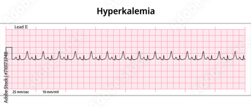 ECG Hyperkalemia - Hyperkalaemia - 8 Second ECG Paper - Electrocardiogram Vector Medical Illustration