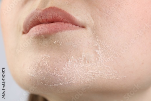 Closeup view of woman with dry skin