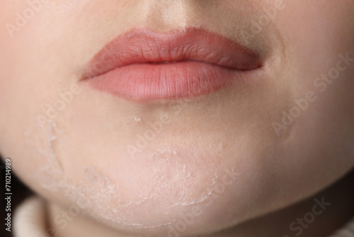 Closeup view of woman with dry skin