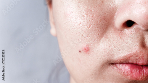 Asian face, Macro skin with enlarged pores. Allergic reaction, peeling, care for problem skin. photo