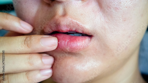 Dry, chapped, peeling lips :dry skin problem with mouth disease photo