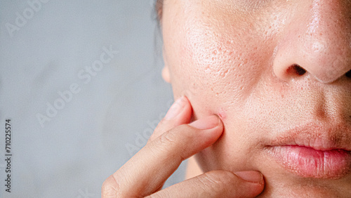 Asian face, Macro skin with enlarged pores. Allergic reaction, peeling, care for problem skin.