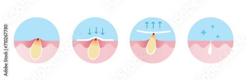 Step of blackhead removal vector icon set illustration isolated on white background. Cross section of blackhead treatment process, apply, peel off, unclogging and tighten pore. Skin care concept. photo