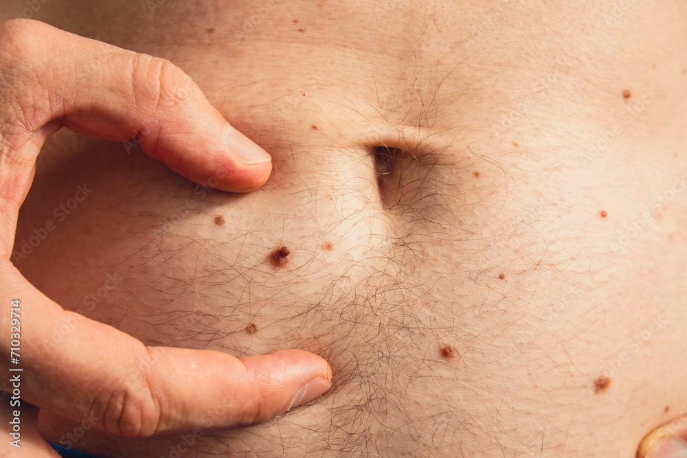 Male hand showing birthmarks on skin body stomach part. Close up detail of the bare skin. Health Effects of UV Radiation. Man with birthmarks Pigmentation and lot of birthmarks Male hand showing birthmarks on skin body stomach part. Close up detail of the bare skin. Health Effects of UV Radiation. Man with birthmarks Pigmentation and lot of birthmarks