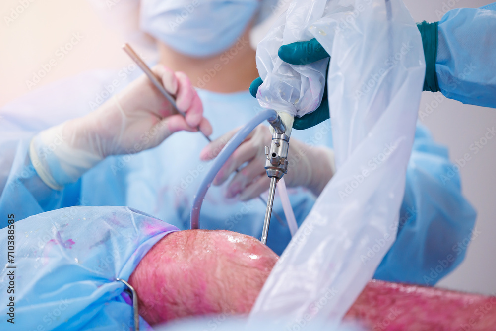 Surgeon use laparoscopic instrument for leg patient minimally invasive