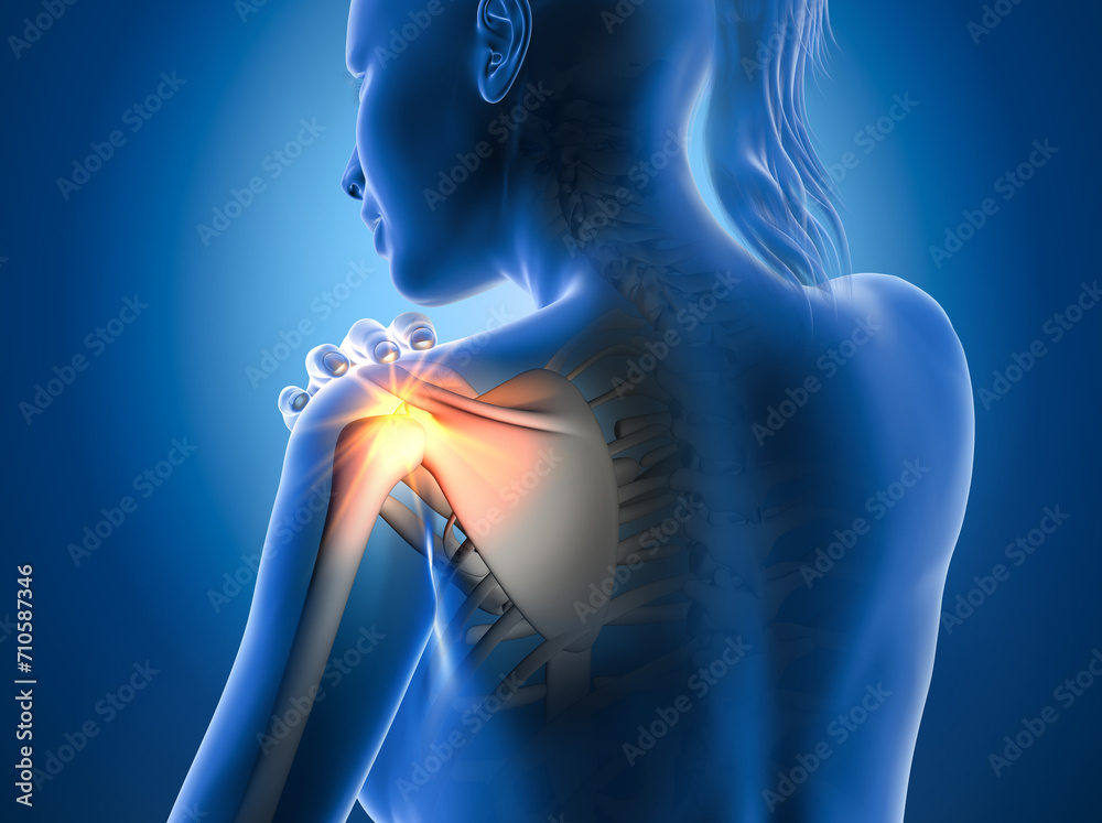 Painful shoulder joints. Frozen shoulder, impingement. 3d illustration ...