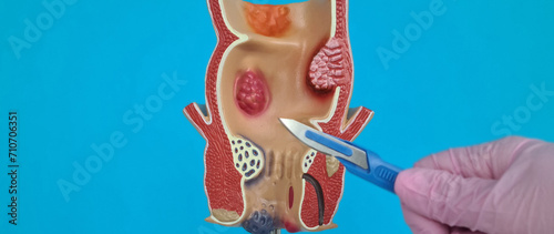 Doctor is holding scalpel anatomy of rectum problem photo