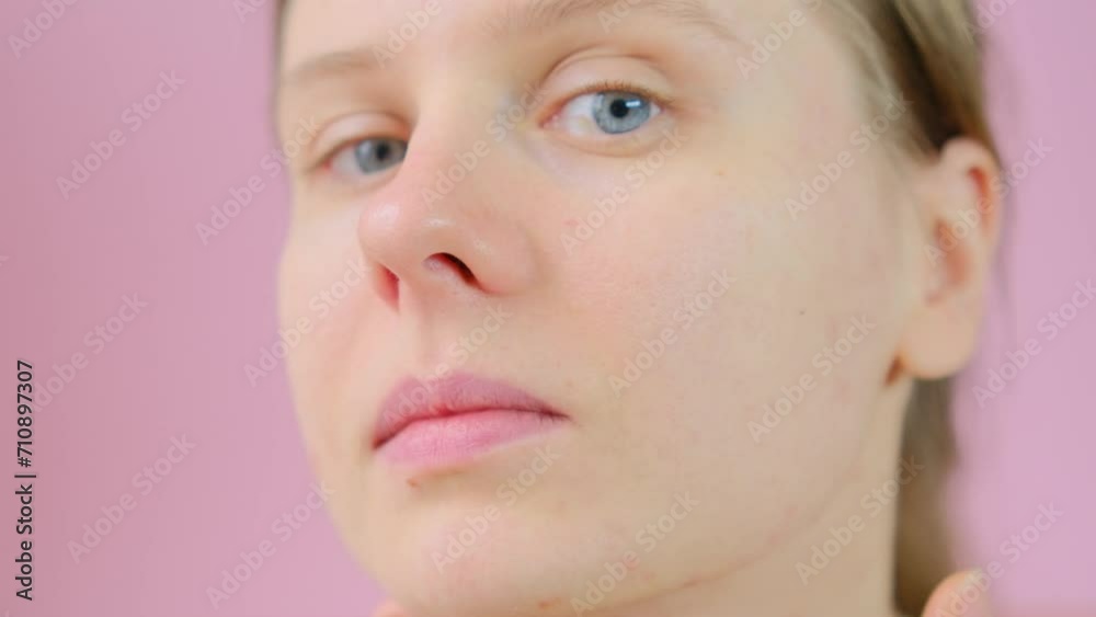 Woman examines her skin with acne and scars in the mirror. Close up skin with acne, peeling and enlarged pores. Woman touching acne on her face. Skin problems, allergic, redness, pimples. Woman examines her skin with acne and scars in the mirror. Close up skin with acne, peeling and enlarged pores. Woman touching acne on her face. Skin problems, allergic, redness, pimples.
