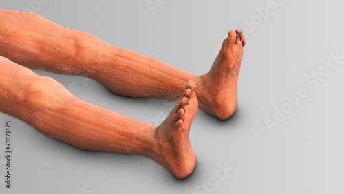 Lower limb edema or swollen legs photo