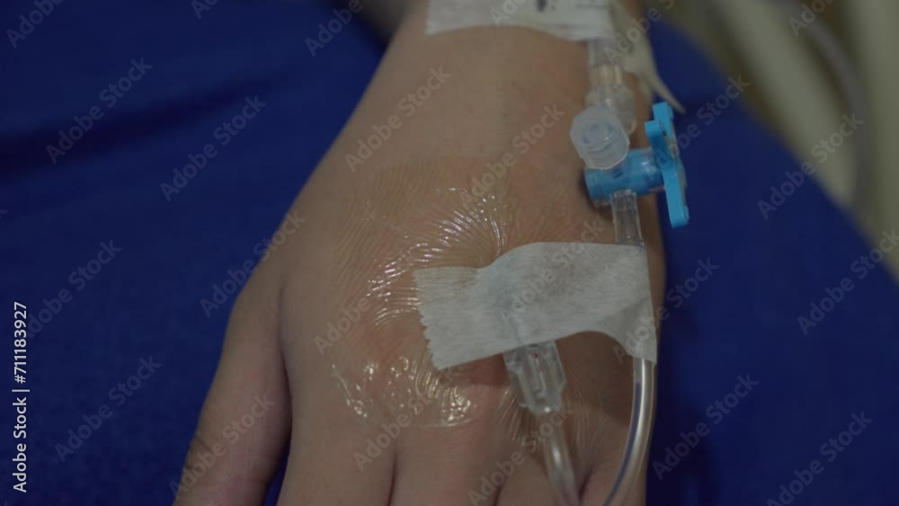Iv Line In Hand Closed up of hand infused with intravenous line IV for receiving fluids ...