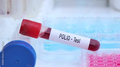 POLIO test to look for abnormalities from blood, scientific experiment